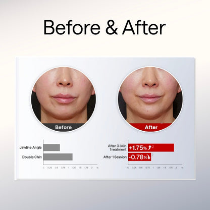 [BIG Promo] Jmoon EM50 Transdermal Collagen Light Beauty Device